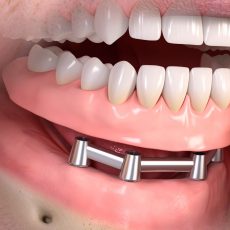 Stéges fogsor 4 implantátumon