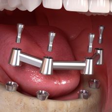 Stéges fogsor 4 implantátumon