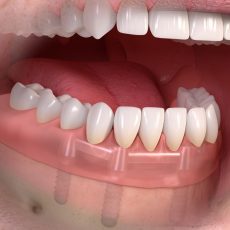 Stéges fogsor 4 implantátumon