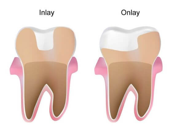 Inlay-Onlay